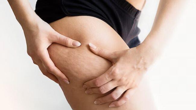 Kupas Tuntas Soal Stretch Mark dan Cara&nbsp;Mencegahnya